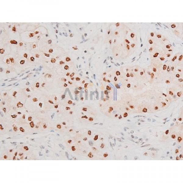 Phospho-JNK1/2/3 (Thr183+Tyr185) Antibody - AF3318 at 1/200 staining Human bladder cancer tissue sections by IHC-P.